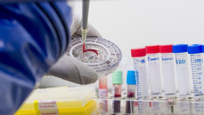 Sejak penyebarannya 30 tahun lalu, AIDS sudah membunuh sekitar 40 juta orang di seluruh dunia.
