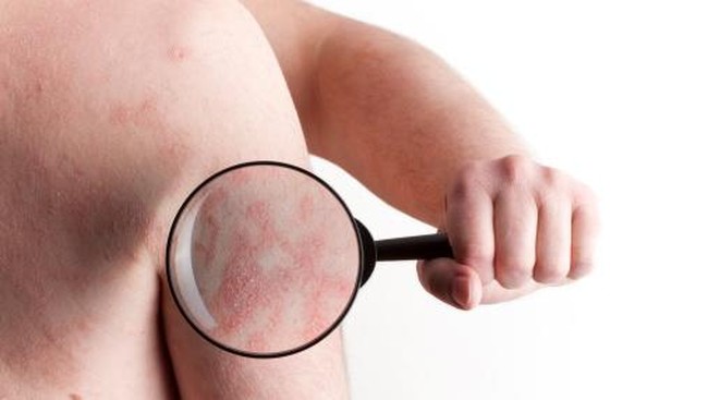 Menanggung Rasa Sakit Kulit Tak Terperi Psoriasis, penyakit ini mungkin masih awam bagi kita. Namun, data WHO menunjukkan tingkat prevalensi di dunia berkisar 2 persen jumlah penduduk.