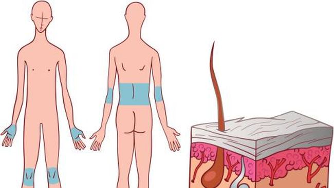 Pengetahuan masyarakat Indonesia yang minim tentang psoriasis membuat para pengidapnya dijauhi karena disangka terkena jamur, penyakit menular, maupun ketombe.