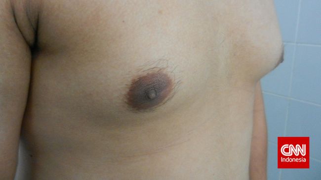 Sekarang ini bukan hanya perempuan yang memiliki ukuran payudara besar. Dalam beberapa kasus modern, ada beberapa kasus pria berpayudara besar.