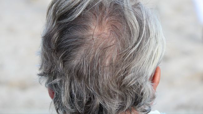 Rambut memutih adalah proses alami. Jika rambut Anda sudah memutih saat masih muda, ini disebut 'premature greying' dan membutuhkan pengobatan.
