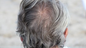 5 Penyebab Munculnya Rambut Putih, Bukan Cuma <i>Mikirin</i> Rakyat