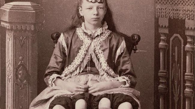 Myrtle Corbin Terlahir dengan normal merupakan anugerah yang tak terhingga. Tapi, bagaimana jika ada orang yang mempunyai anggota tubuh 'ekstra'?