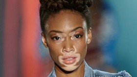 Model Pengidap Vitiligo Merajai Ranah Fesyen