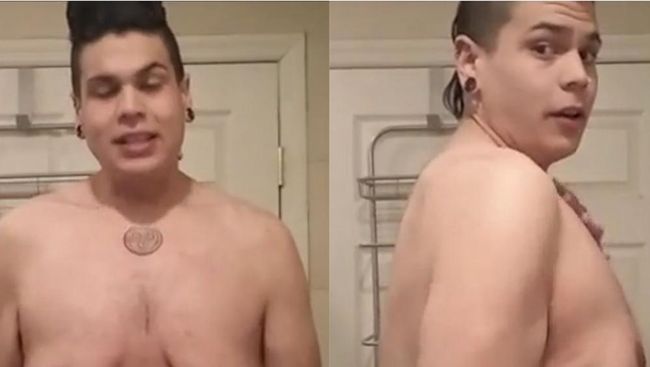 Dari wajah hingga bahu, tak ada yang aneh dengan Matt Diaz. Namun, ketika ia memperlihatkan bagian dada dan perutnya, terlihat gelambir kulit yang menyeramkan.