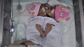 Bayi Kembar Siam Asal Tapanuli Utara Dirawat di Medan