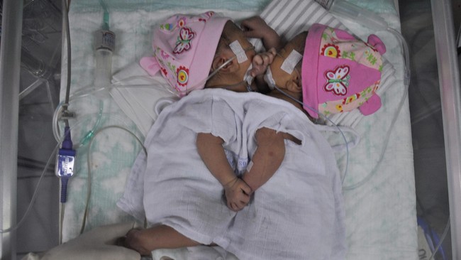 Bayi kembar siam asal Kabupaten Tapanuli Utara (Taput) terpaksa dirujuk ke Rumah Sakit Umum Pusat (RSUP) Haji Adam Malik, Medan, Sumatera Utara.