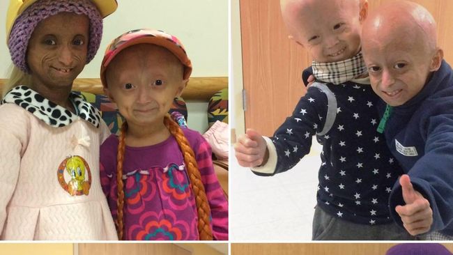 Seorang gadis remaja berusia 18 tahun terperangkap di tubuh nenek-nenek berusia 144 tahun. Kondisi ini terjadi karena penyakit langka progeria.
