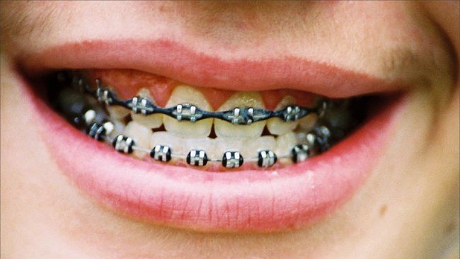 5 Kesalahan Yang Sering Dilakukan Saat Pakai Kawat Gigi