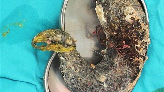 Gumpalan rambut kencang, yang diperkirakan sudah berkembang selama beberapa tahun, berbentuk persis seperti perut si gadis kecil.