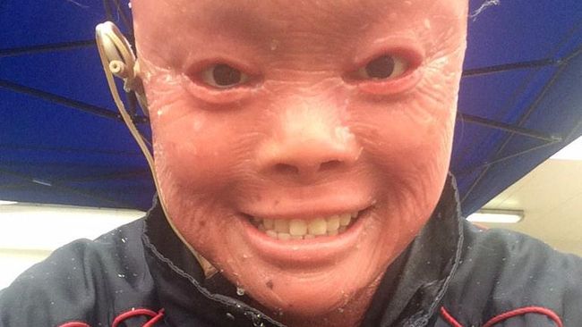 Kisah Mui Thomas, 'Manusia Ikan' dengan Kulit Penuh Sisik Kulit Mui sangat tebal, kering dan berbentuk seperti serpihan yang mirip dengan sisik ikan. Dia tidak bisa berkeringat namun bisa menangis.