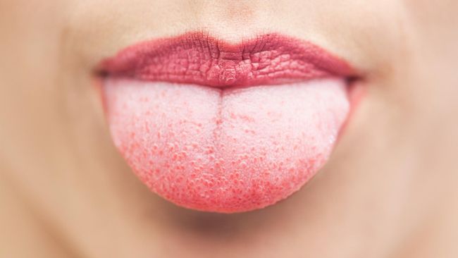 Batu es yang diikuti dengan konsumsi obat tertentu bisa mengatasi masalah lidah terbakar akibat mengkonsumsi makanan atau minuman panas.