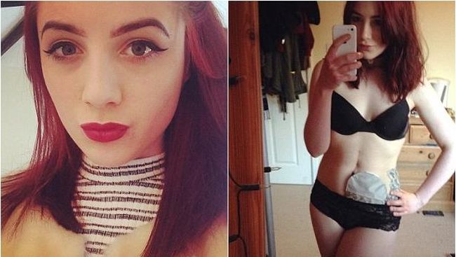 Hattie Gladwell baru berusia 19 tahun, tapi ia telah menjalani operasi menakutkan yang membuatnya harus hidup dengan kantong ostomy.