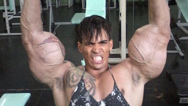 Romario Dos Santos Alves (25) berani mempertaruhkan nyawa dengan menyuntikkan minyak dan alkohol ke bisep di kedua lengannya.