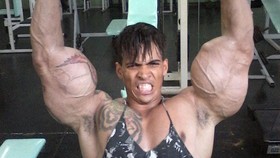 Kisah 'Manusia Monster' Suntik Minyak ke Otot Demi Mirip Hulk