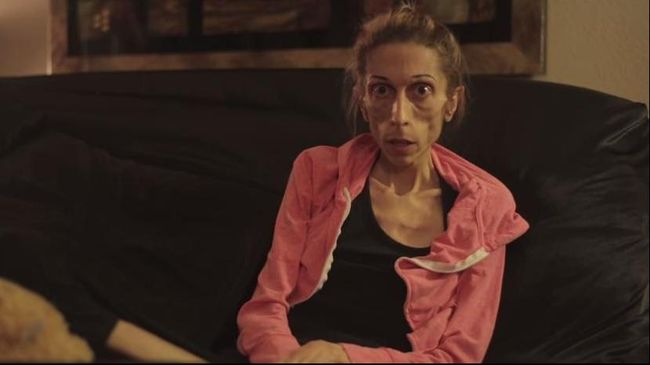 Rachael Farrokh (37), perempuan asal San Clemente, California, telah berjuang melawan anoreksia nervosa selama 10 tahun.