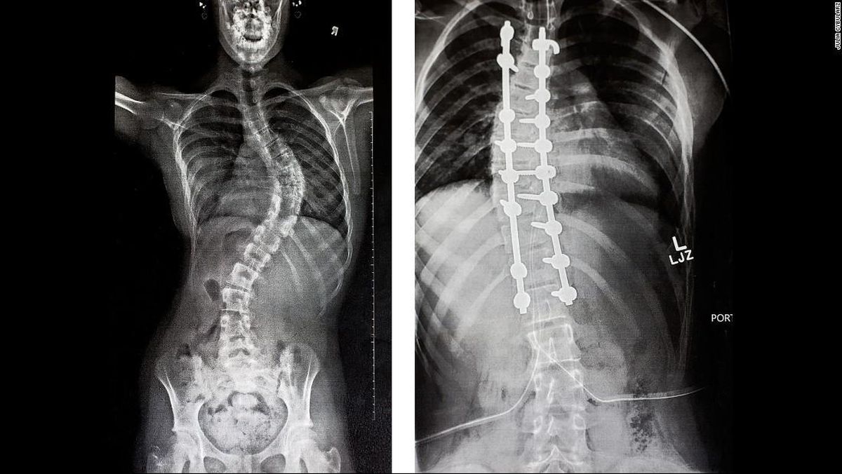 Understanding De Novo Scoliosis in the Elderly: Challenges and Insights