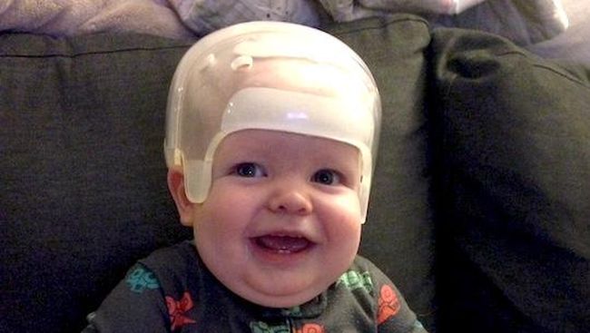 Bayi Terlahir Tanpa Ubun-ubun karena Tulang Tengkorak Menyatu Matthew Boler, lahir 16 Juli 2014 di Texas Children’s Pavilion for Women. Dia tampak begitu mirip dengan kakak perempuannya, kecuali bentuk kepalanya.