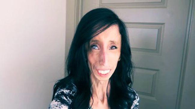 Lizzie Velasquez (26) terlahir dengan sindrom Marfan, kondisi langka yang tidak memungkinkan tubuhnya untuk menumpuk lemak.