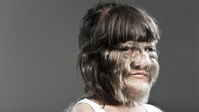 Dia lahir dengan penyakit langka yang disebut sebagai hipertrikosis atau sindrom Ambras yang menyebabkan tubuhnya dipenuhi rambut dengan jumlah abnormal.
