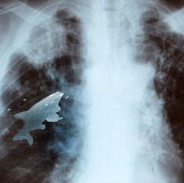 Ini Gejala dan Tanda Kanker Paru-paru Menurut Dokter