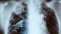 Ini Gejala dan Tanda Kanker Paru-paru Menurut Dokter