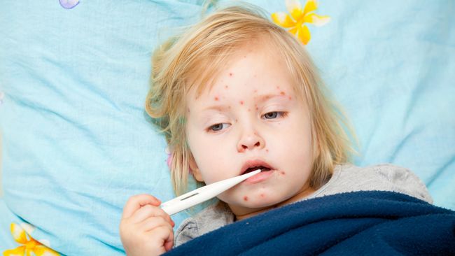 Beberapa penyakit tampak mirip termasuk campak dan cacar air. Padahal keduanya berbeda.