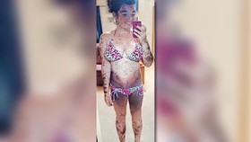 Gadis yang Lahir dengan Ratusan Tahi Lalat di Sekujur Tubuh