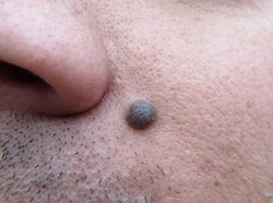 Muncul Tahi Lalat yang Tak Wajar? Awas Tanda-tanda Kanker Kulit