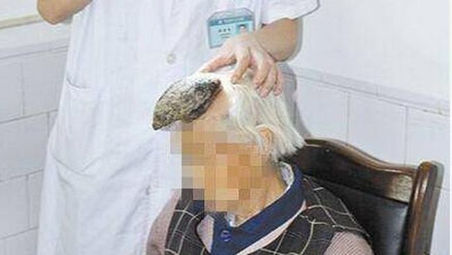 Tanduk tersebut sudah ada di kepala nenek berusia 87 tahun itu selama kurang lebih dua tahun. Dan sampai sekarang, tanduk tersebut masih terus tumbuh.
