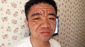 Pria 30 Tahun Berwajah Kakek-kakek karena Penyakit Misterius