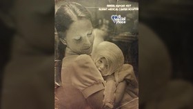 Setelah 4 Dekade, Bayi dengan Luka Bakar Bertemu Perawatnya