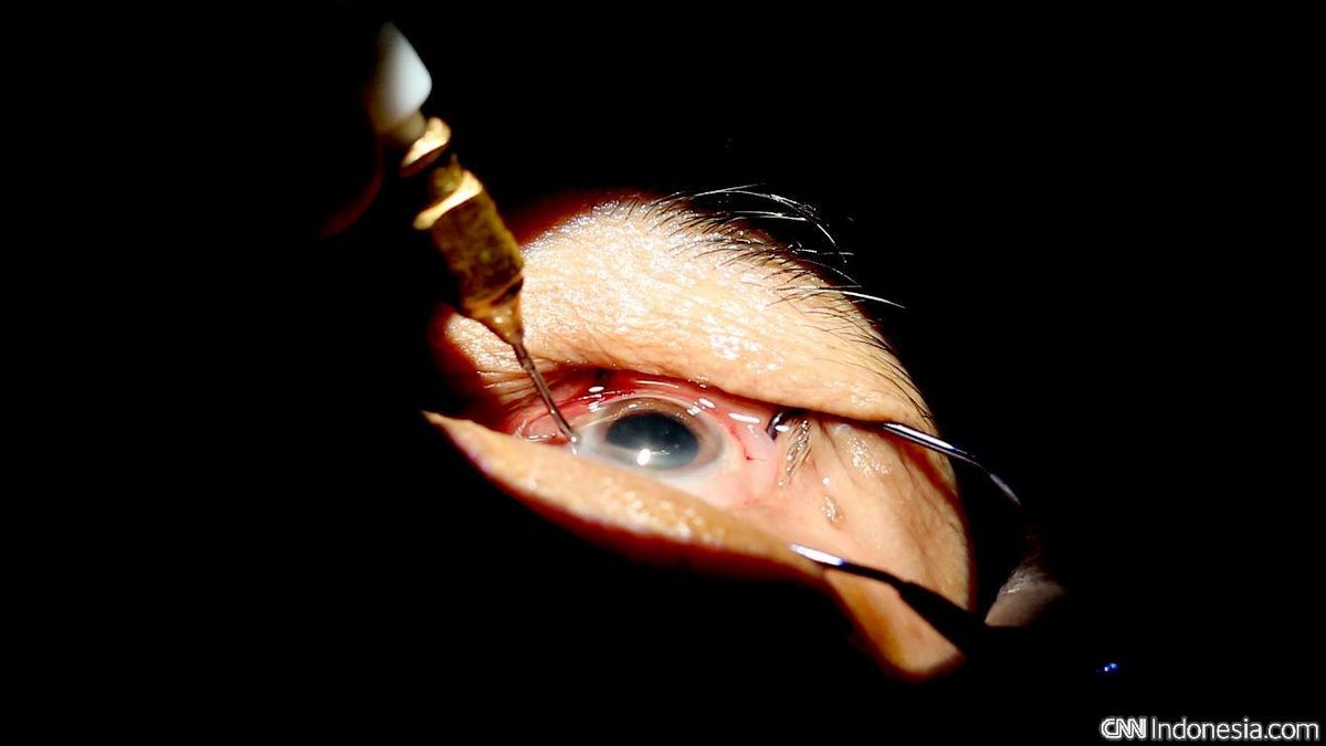 Ini Daftar Operasi yang Ditanggung BPJS, Katarak hingga Usus Buntu