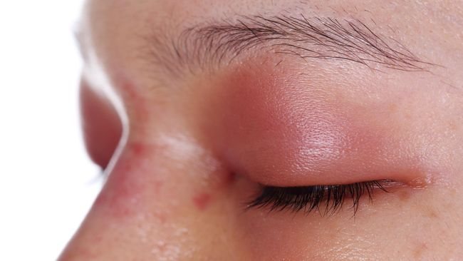 Seorang perempuan mengalami orbital emphysema yang jika tidak segera ditangani dapat membuat matanya buta.
