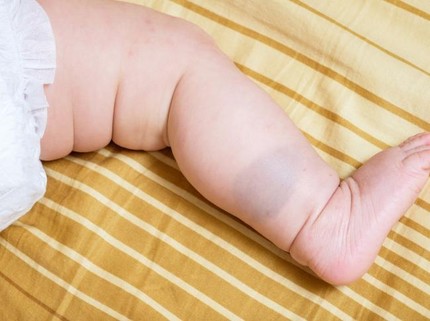 5 Mitos & Fakta Tanda Lahir Bayi, Salah Satunya Bisa Tunjukkan Karakter