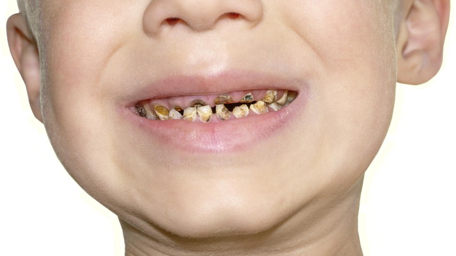 Ini Lho Bun Penyebab Gigi Gigis pada Anak