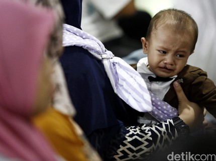 Bunda, Ketahui Penyebab dan Risiko Bibir Sumbing pada Bayi