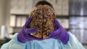 Mengenal Glioblastoma, Kanker Otak yang Diidap Agung Hercules