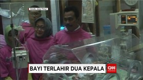 Bayi Terlahir Dua Kepala