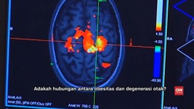 img-title Obesitas Picu Degenerasi Otak