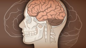 Angka Kerugian Akibat Demensia