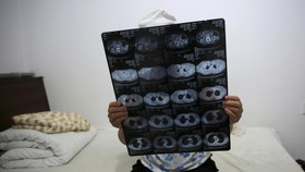 Seputar Kanker pada Anak