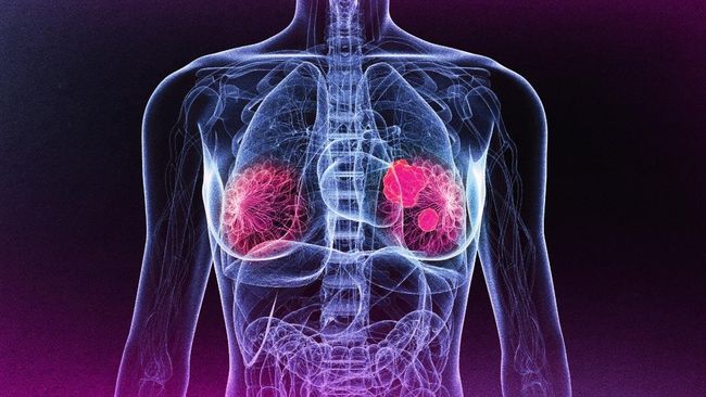 Global Burden of Disease Cancer Collaboration menyebutkan, sepanjang 2015 tercatat 17,5 juta kasus kanker di dunia, yang menyebabkan 8,7 juta kematian.