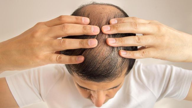 Generasi Millennial Rentan Alami Kerontokan Rambut