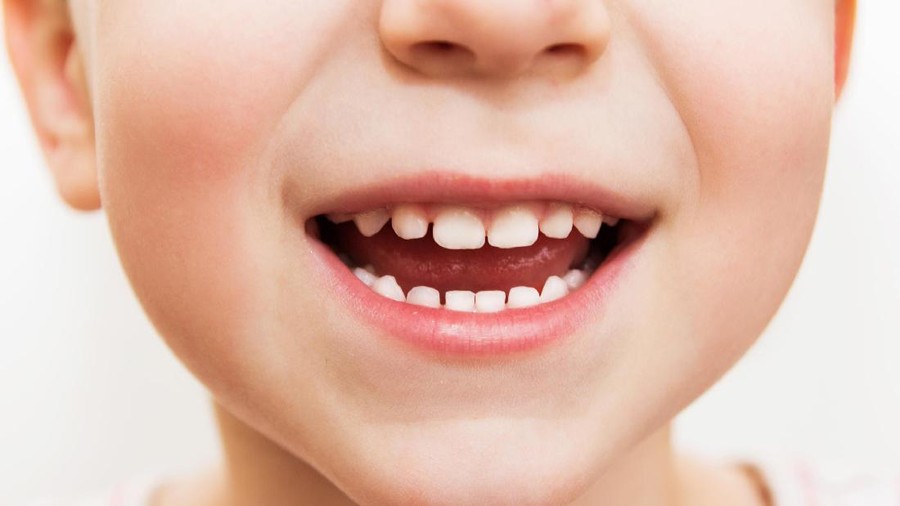 Aturan Konsumsi Asupan Manis agar Anak Tak Gampang Sakit Gigi