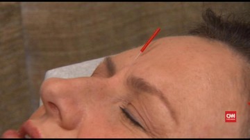 Akupuntur Wajah Lebih Aman dari Botox
