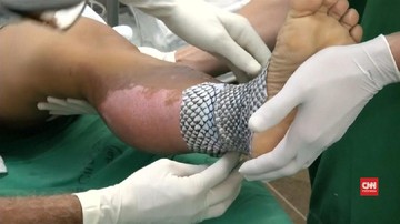 Apa Benar Kulit Ikan Ampuh Buat Luka Bakar? Begini Hasil Studinya