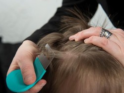 10 Cara Membasmi Kutu Rambut Beserta Telurnya, Mudah dan Cepat!