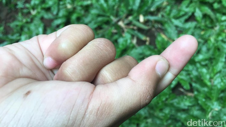 Anak kesusupan, ada serpihan sesuatu di jarinya. Apa itu bisa keluar dengan sendirinya?