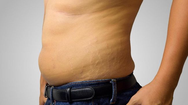 Seniman asal Spanyol mendobrak stigma bahwa stretch mark adalah hal yang buruk. Ia pun menampilkannya dalam karya seni kontroversial.
